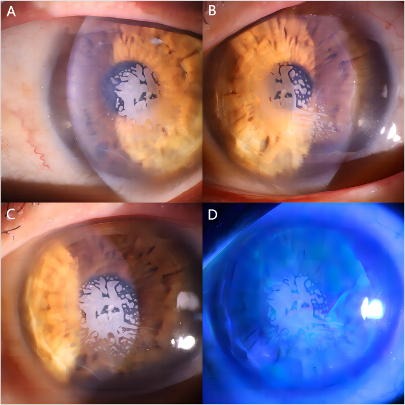 Поздняя дислокация лоскута через 24 года после LASIK с врастанием эпителия