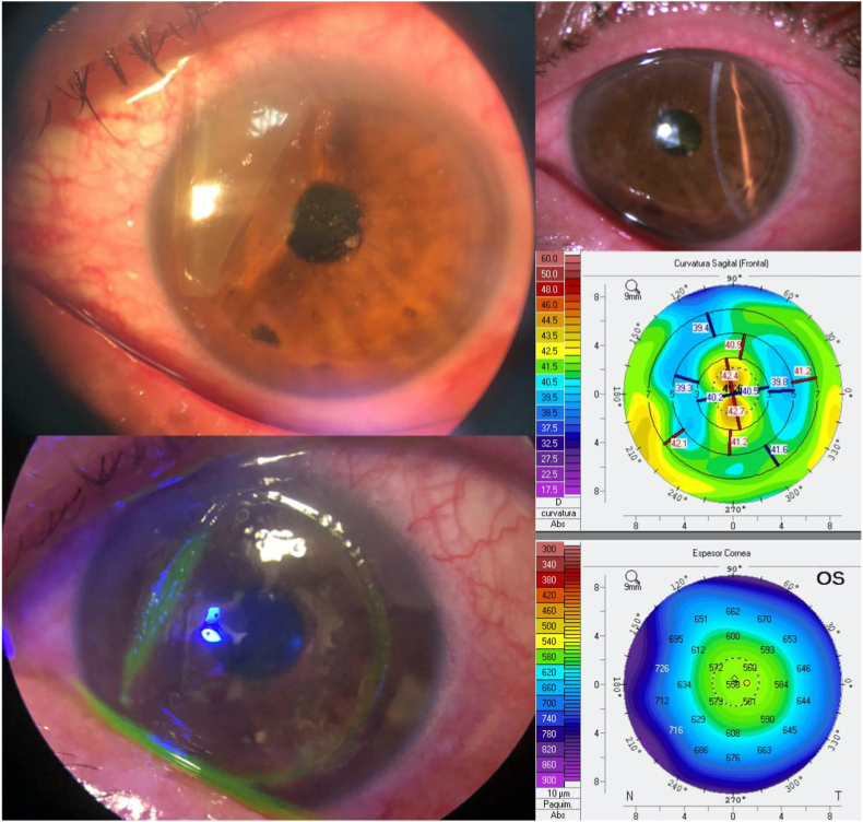 Дислокация лоскута после укуса собаки через 16 лет после LASIK: лоскут заломлен у носового шарнира